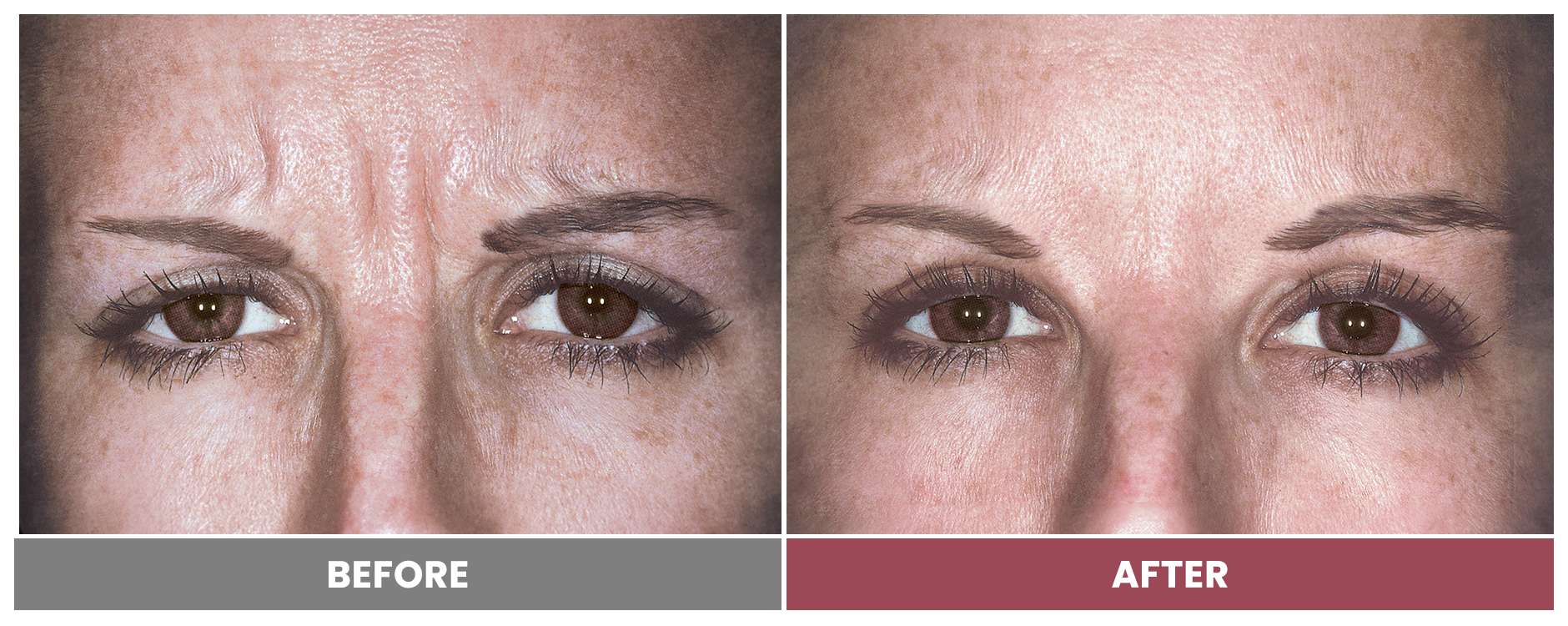 BOTOX FOR WRINKLES & BROW LIFT - Case 18